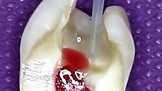 Pulpotomy Procedure This is How Tooth is Cleaned and Prepared for Dental Cavity  Tooth Filling [upl. by Enrobyalc296]