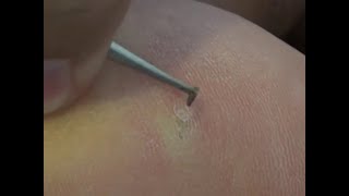 Splinter Removal  Splinter remove from leg [upl. by Arvad723]