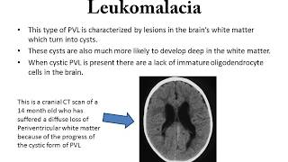 Periventricular Leukomalacia [upl. by Erreid]