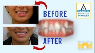 Invisalign Before and After Crowded Teeth [upl. by Eoz]