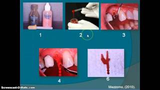 Reconstrucción de muñón en dientes tratados endodónticamente [upl. by Nala]