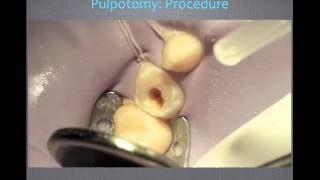 Pulp Therapy and Primary Tooth Pulpotomy  Video Review [upl. by Reave]