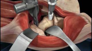 Direct Anterior Approach Hip Replacement [upl. by Balfore342]