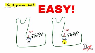 Dentigerous cyst made easy [upl. by Seiter605]