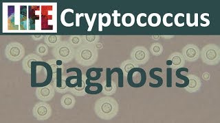 Diagnosing cryptococcal meningitis [upl. by Eneirda]