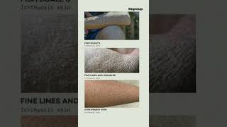 Ichthyosis Treatment Effective Solutions for Skin Condition  Your Guide to Treating Ichthyosis [upl. by Garris819]