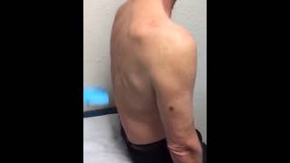 Shoulder Steroid Injection by Dr Gawayne Vaughan  Auburn Medical Group [upl. by Araek]