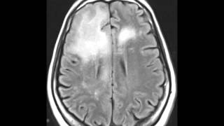 Progressive Multifocal Leukoencephalopathy [upl. by Loring]