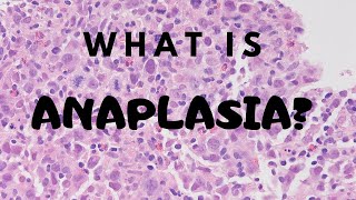 What is Anaplasia  Pathology mini tutorial [upl. by Nillor958]