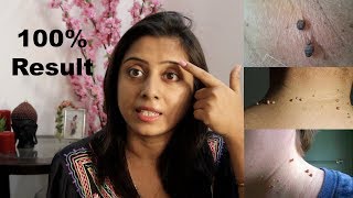 Remove Skin Tags in 1 Night  3 Amazing Way to Remove Skin Tags  Preventing Naturally Soumali [upl. by Anived]