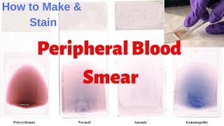 Peripheral Blood Smear Peripheral Smear Examination  Leishmans Staining Procedure [upl. by Asiela]