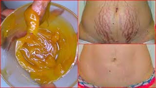 REMOVE STRETCH MARKS FAST HOW TO GET RID OF STRETCH MARKS EFFECTIVELY  Khichi Beauty [upl. by Haila920]