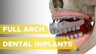 Full Arch Dental Implants [upl. by Ahsinrev]