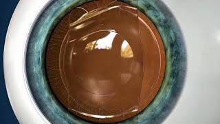 Vision Correction for High Levels of Myopia amp Astigmatism [upl. by Alecram]