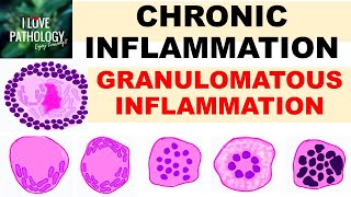 INFLAMMATION Part 9 Chronic Inflammation  GRANULOMATOUS INFLAMMATION [upl. by Aloysia434]