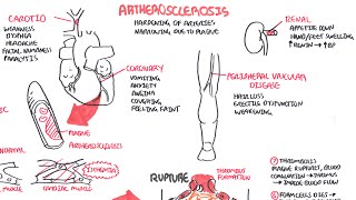 Atherosclerosis  Pathophysiology [upl. by Mufinella739]