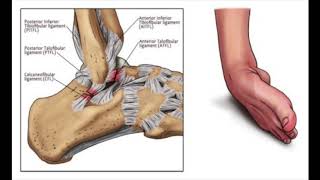 Lateral Ankle Sprains Anatomy Overview [upl. by Iveksarap580]