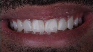 Anterior direct composite resin  layering of multiple teeth in one visit handson [upl. by Obeng]