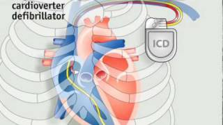 How pacemakers work [upl. by Kenlee15]