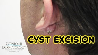 Stubborn Reoccurring Cyst Needs Removal [upl. by Talbott]