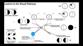 Lesions to the Visual Pathway EXPLAINED [upl. by Kalagher]