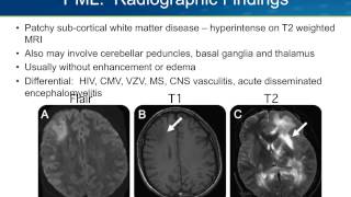 Progressive Multifocal Leukoencephalopathy PML [upl. by Alyak]