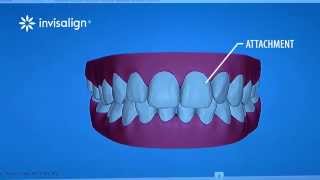 What You Can Expect During Invisalign Treatment [upl. by Ttiwed984]