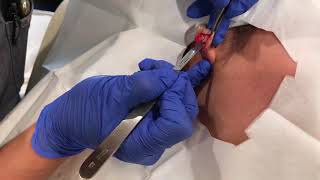 Keloid Removal Ear  Dr Johnson C Lee MD Plastic Surgery [upl. by Harehs]