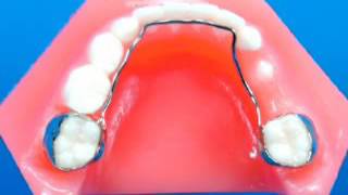 Lingual arch Dental Appliance SMLGlobal [upl. by Gilburt]