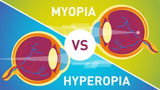 Difference between Myopia Near Sightedness amp Hyperopia FarSightedness [upl. by Dombrowski422]