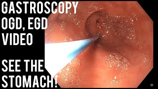 Gastroscopy  OGD  See inside the stomach [upl. by Zaria]