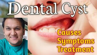 Dental Cyst and Infection Causes Symptoms Types and Treatment [upl. by Eical]