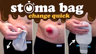 How to change an ostomy bag — quicker than 1 minute [upl. by Eneluqcaj]