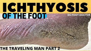 Ichthyosis of the Foot Travelin Mans Severe Skin Condition and Treatment [upl. by Aneekas]