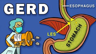 Gastroesophageal Reflux Disease GERD [upl. by Tavia]