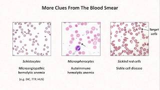 Anemia Lesson 4  Clues from the blood smear [upl. by Sicnarf]