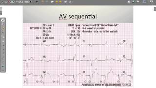 ECG Paced Rhythms [upl. by Sal]