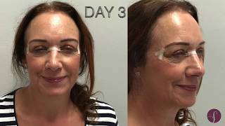 Eyelid Surgery Blepharoplasty LIVE SURGERY Before and After [upl. by Gennie]