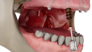 Straumann Pro Arch Step by Step Overview [upl. by Sol]