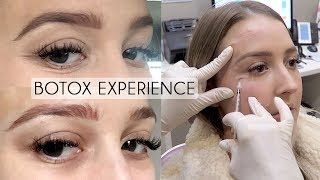 UNDER EYE BOTOX Experience amp Footage  BeforeAfter Cost Pain Bruising [upl. by Mcnully]