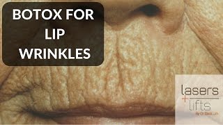 BOTOX for lip wrinkles [upl. by Rakso966]