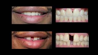 Invisaign for Teeth Gap Treatment at Cosmetic Dental Associates [upl. by Enilarak]