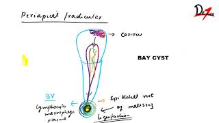 Radicular cyst  PATHOGENESIS CF RF amp TREATMENT [upl. by Adnalay]