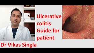 Ulcerative colitis Treatment and Symptoms अल्सरेटिव कोलाइटिस In Hindi Dr Vikas Singla [upl. by Nnairrek]