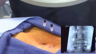 WATCH an Epidural Steroid Injection Demonstration  LIVE [upl. by Vasilek715]