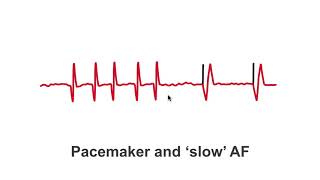 Pacemakers and slow AF patients [upl. by Jacoby448]