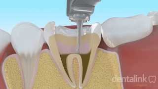 Endodoncia completa PASO A PASO  Video 3D [upl. by Riccardo878]