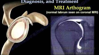 Upper and Lower Motor Neuron Lesions [upl. by Euh942]