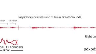 The Lung Sounds of Pneumonia [upl. by Irwin]