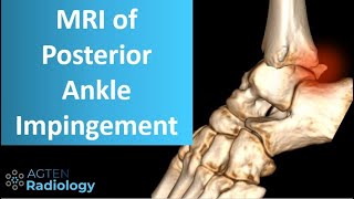 Posterior ankle impingement on MRI [upl. by Bihas]